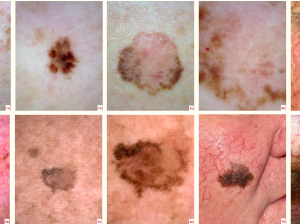 Melanoma