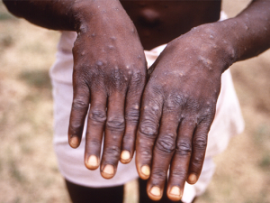 Monkeypox rash [image CDC]