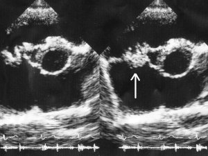 Echocardiogram