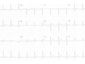 ECG