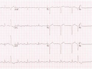 ECG