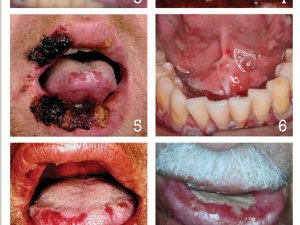 Mouth Ulcers