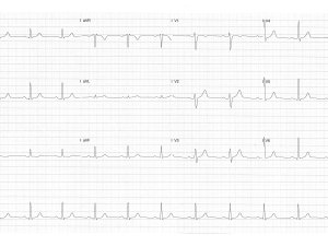 ECG 