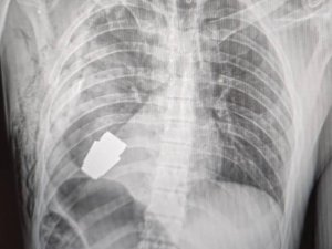 Ukraine soldier chest x-ray [Credit: Ukranian deputy defense minister Hanna Maliar, Facebook