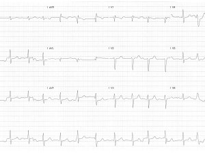 ECG