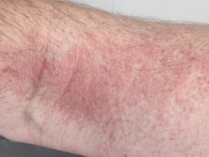 Mild atopic dermatitis