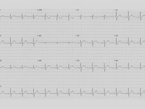 ECG