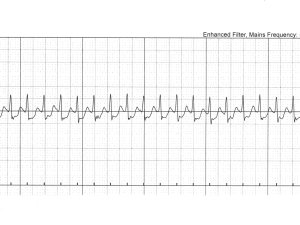 ECG