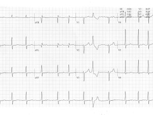 ECG