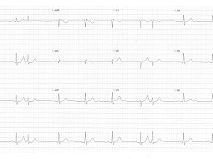 Heartbeat-2-Aug-2023-ECG