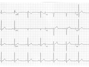 Heartbeat-ECG