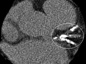 CT calcium score test