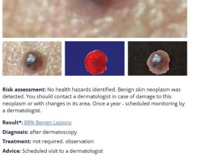 skin lesion scanning result