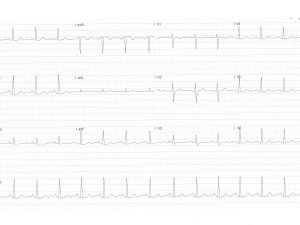 ECG