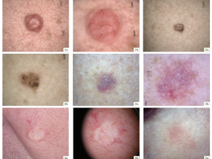 non-melanoma skin cancers