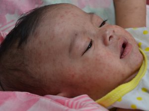 Child with measles