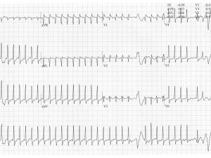 Heartbeat ECG