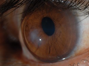 Eye