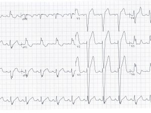 ECG