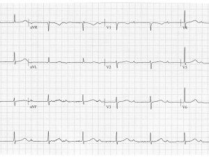 Heartbeat-ECG-10-Apr-2024