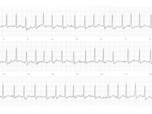 Heartbeat ECG