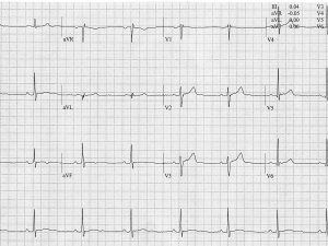 Heartbeat-ECG-28-Aug-2024