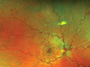 Figure-1-retinal-vein-occlusion