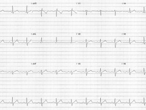 Heartbeat-ECG-25-Sep-2024