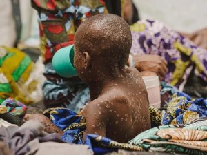 Mpox in the DRC [Image: Unicef]