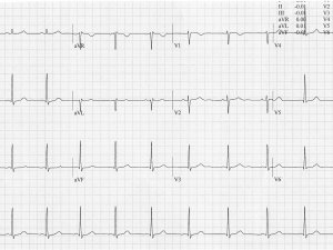 Heartbeat ECG 23 Oct 2024