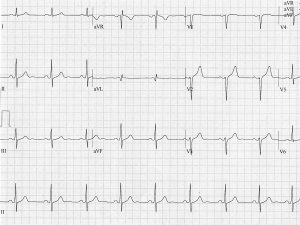 Heartbeat ECG 20 Nov 2024