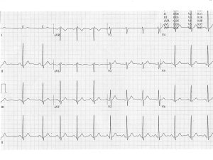 Heartbeat-ECG-Feb