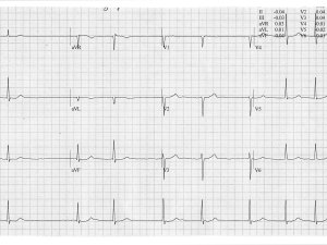 Heartbeat-ECG-Mar-2025