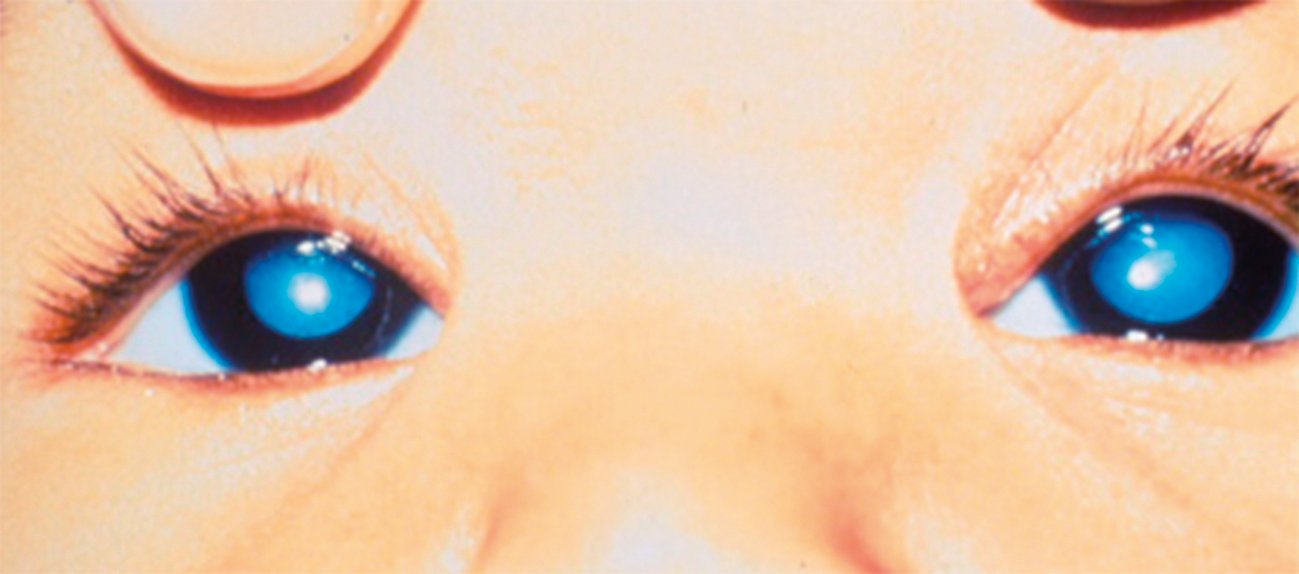 Figure 1. Bilateral congenital cataracts – note the loss of the red reflex in both eyes, and the white pupils (leukocoria) (Image courtesy of Dr Shuan Dai)