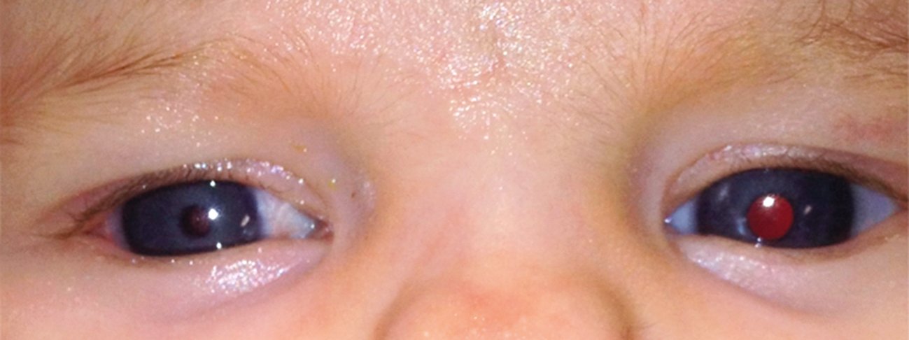 Figure 2. Right congenital cataract with microphthalmia – note the loss of the red reflex in the right eye, as well as the smaller right pupil and eye size; no leukocoria is present in this case (Dr Shuan Da)