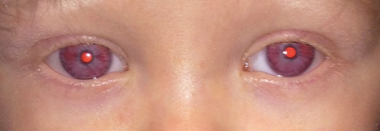 Figure 4. Ocular albinism – note the presence of bilateral iris transillumination (Dr Shuan Dai)