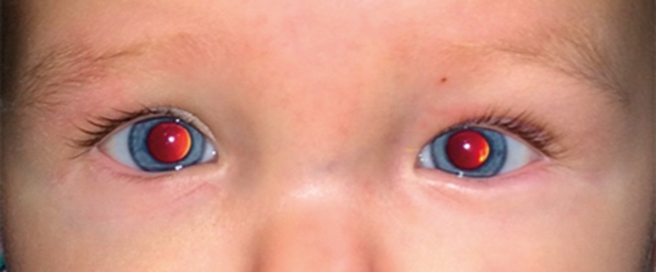 Figure 5. Normal red reflex – equal in colour and intensity, symmetric in both eyes, with no dark spots, opacities or white reflexes(Dr Shuan Dai)